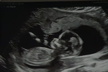 Using 20 week NHS anomaly scan measurements and gender prediction