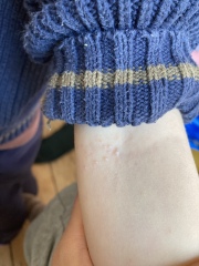 What is this rash?