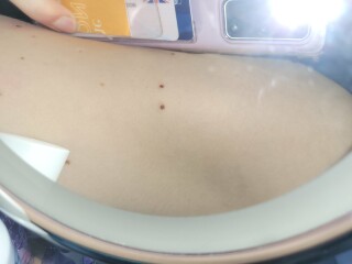 Any GPs around...odd new moles...