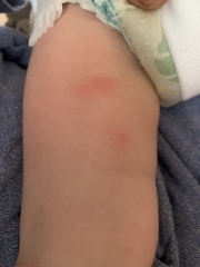 Baby being bitten!!! By what?