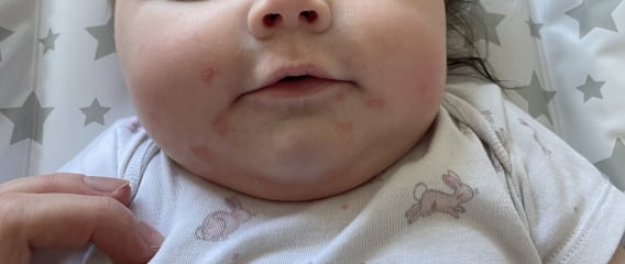 Does this look like impetigo to anyone