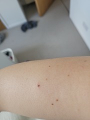 Any GPs around...odd new moles...