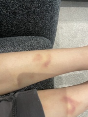 Bruising on child legs with no explanation 