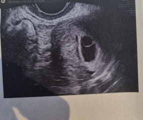 Scared , Brown bitty discharge for 5 days