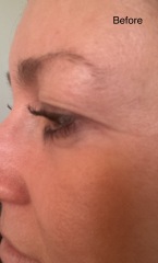 Upper Blepheroplasty