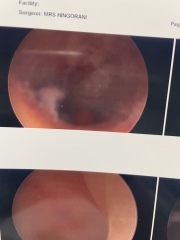 Does anyone know anything about hysteroscopy results images ? Pic attatched here 