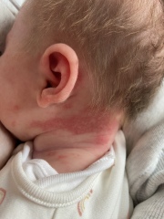 My newborn has a rash and I’m sure what to do?!