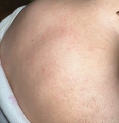 IScarlet fever or heat rash