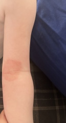 Can anyone identify this rash?