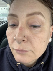 CPAP indentation on nose