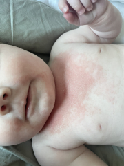 Awful dribble rash pics