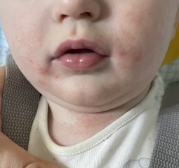 What could be causing this rash on my baby's face??