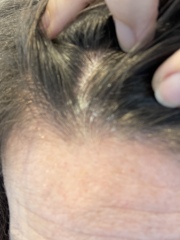 Is this dandruff?! 