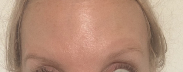 Botox before and after