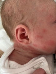 My newborn has a rash and I’m sure what to do?!