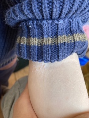 What is this rash?