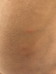 What is this skin thing?