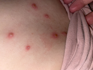 To ask how do you know if chicken pox is infected?