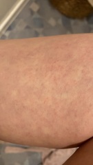 Weird rash and a mark. I'm PREGNANT and worrying.