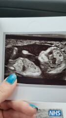 Gender prediction-nub theory