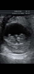 Gender guesses based on placenta / nub?