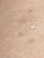 Stucco Keratosis?  Wart growths...photos included