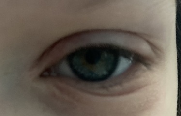 Why has my 7 year old got bags under their eyes? (pics attached)