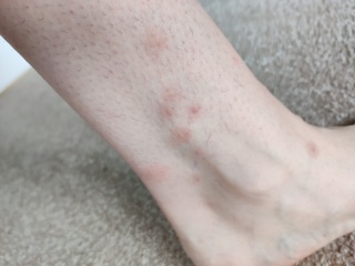 Help - I'm being eaten alive by some little creature - need solutions and advice 