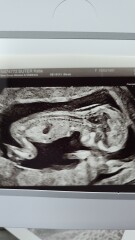 Gender prediction-nub theory