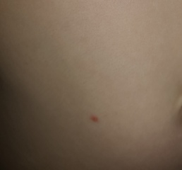 Chicken pox? 