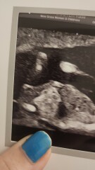 Gender prediction-nub theory