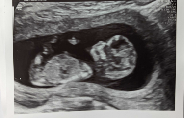 12 week and 20 week scan pictures - Boy or girl? Predictions welcome!