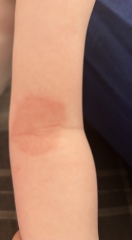 Can anyone identify this rash?