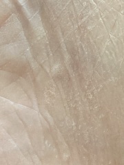 Stucco Keratosis?  Wart growths...photos included