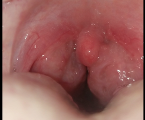Would you mind looking at my throat? (Picture warning)