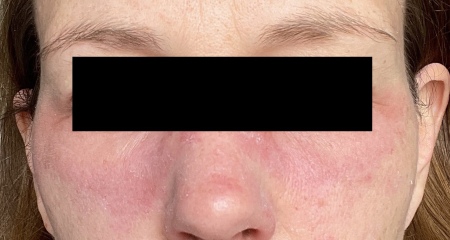 Very red, hot face. Advice needed. 