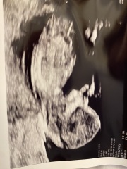 12 week scan, nub/skull guesses?