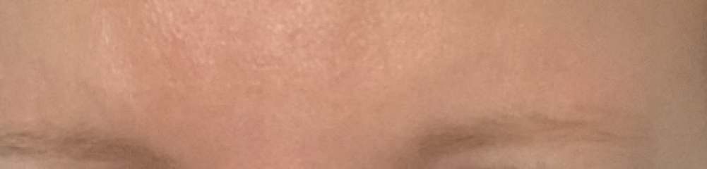 Botox before and after