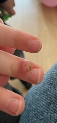 Wart  