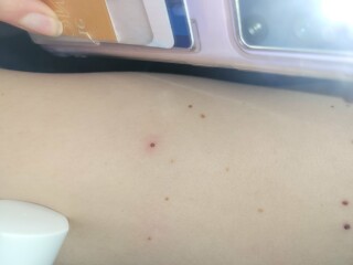 Any GPs around...odd new moles...