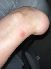 Red itchy lump