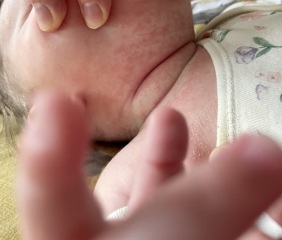 Awful dribble rash pics