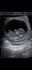 Gender guesses based on placenta / nub?