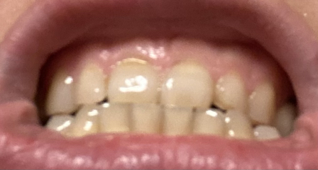 I'm about to cry about my teeth