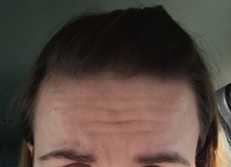 Botox before and after