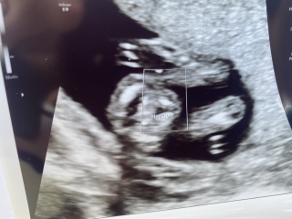 CanAnyone help me figure out my scan pics please