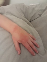 Ds sore red/swollen hands