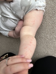 What’s this rash on my 1 year old? 
