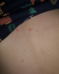 Chicken pox? 