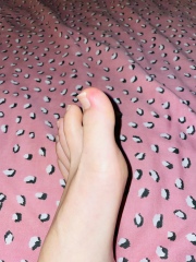 Chilblains? 